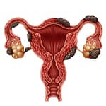 Es la endometriosis una enfermedad genética
