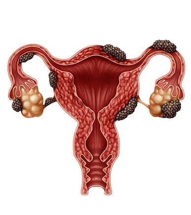 Es la endometriosis una enfermedad genética