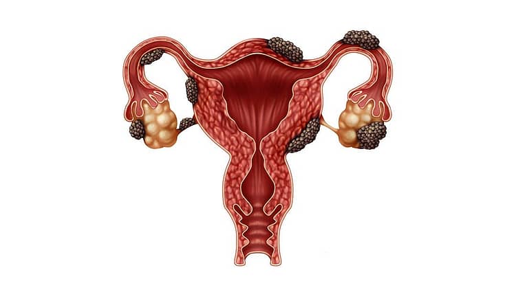 endometriosis